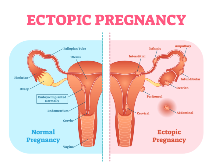 what is an ectopic pregnancy what is an ectopic pregnancy