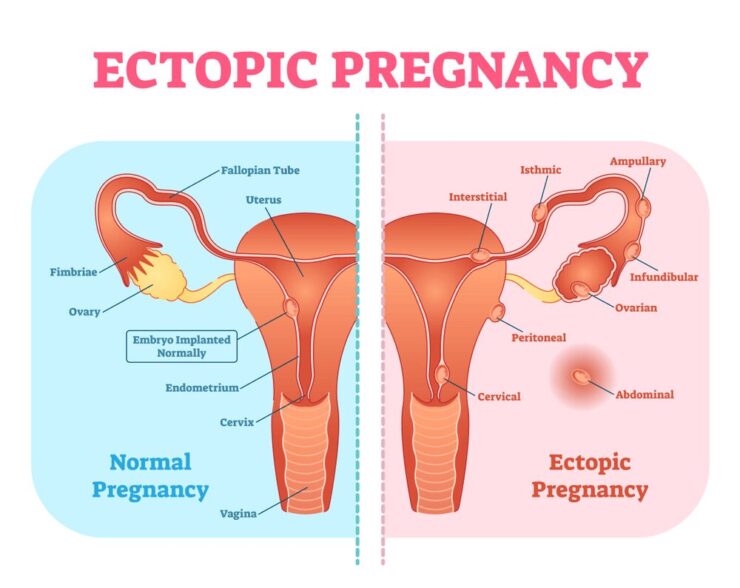 what is an ectopic pregnancy
