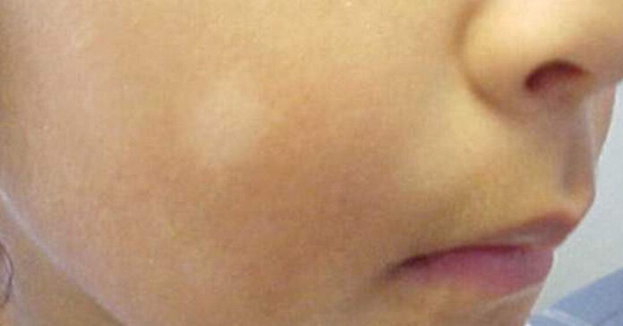 7 Super Easy Ways to Remove White Patches on Baby Face